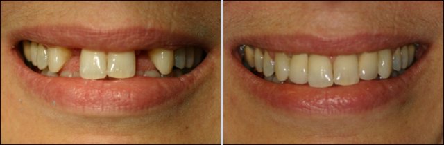 Two dental implants for lateral incisors