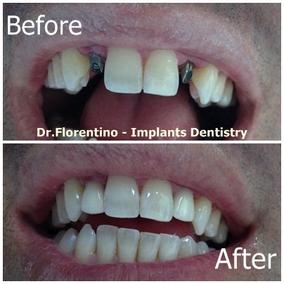 2 dental implants for lateral incisors