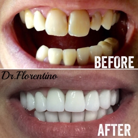 Smile MakeOver with Zirconia Crowns(metal free)