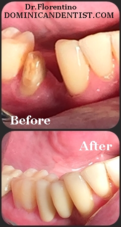 Dental Bridge - Dr.Florentino - Dominican Dentist