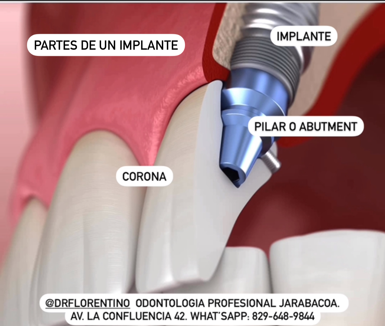 Implante dental
