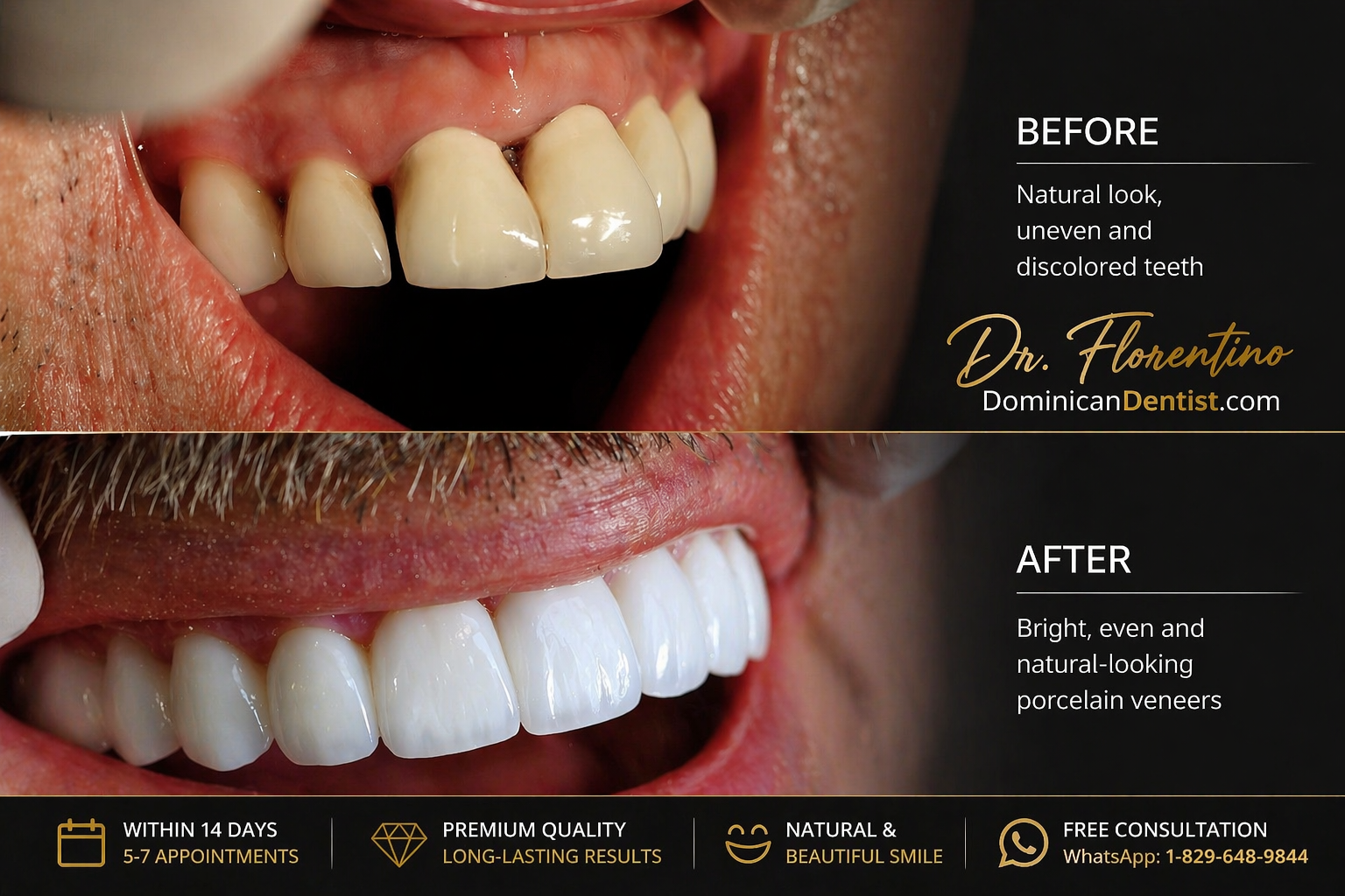 Cost of Porcelain Veneers in Dominican Republic
